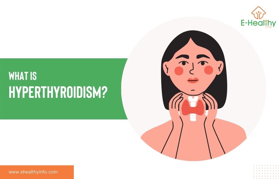 Hyperthyroidism – Overactive Thyroid Gland