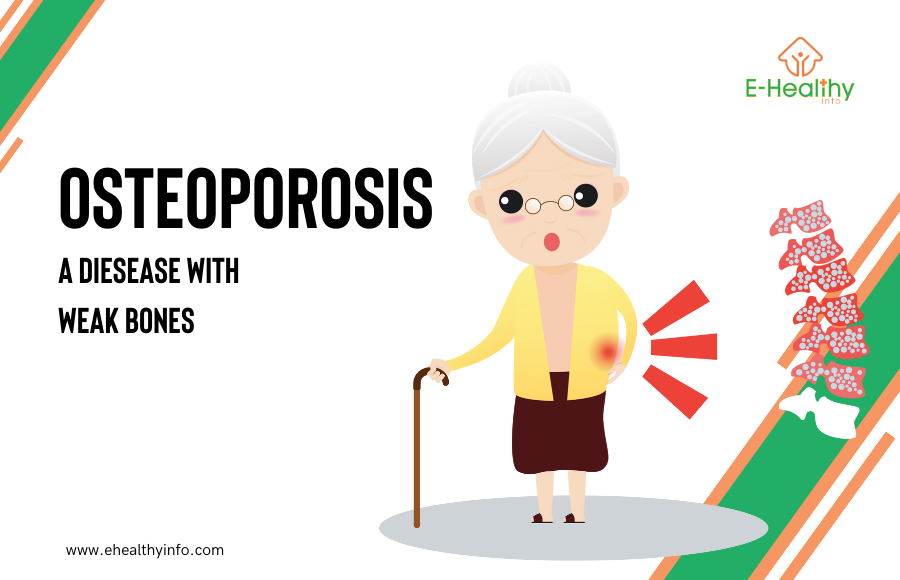 Understanding Osteoporosis: “Symptoms, Diagnosis and Treatment”