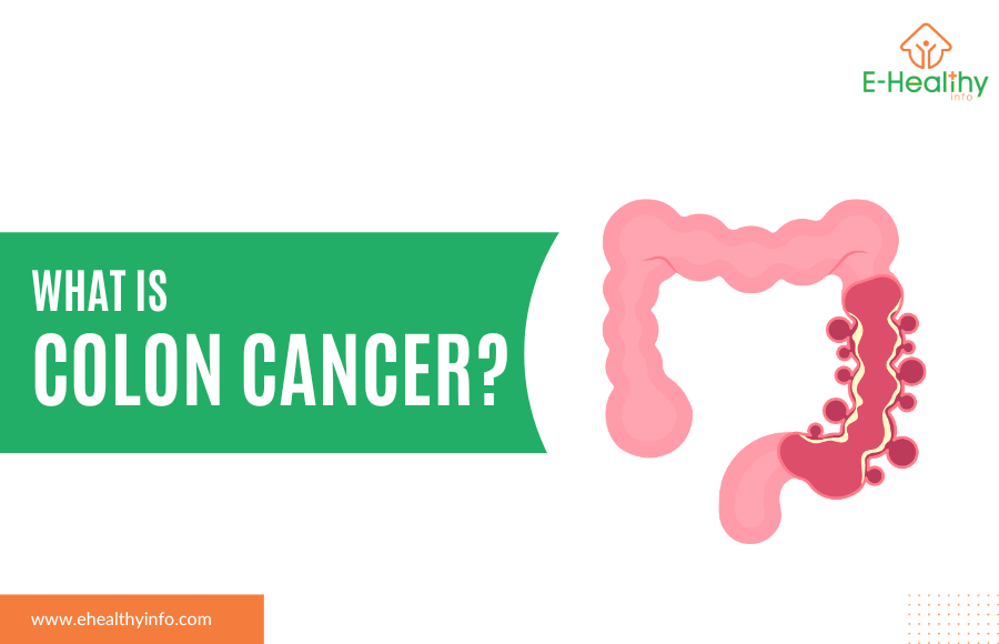Colon Cancer – What do you need to know?