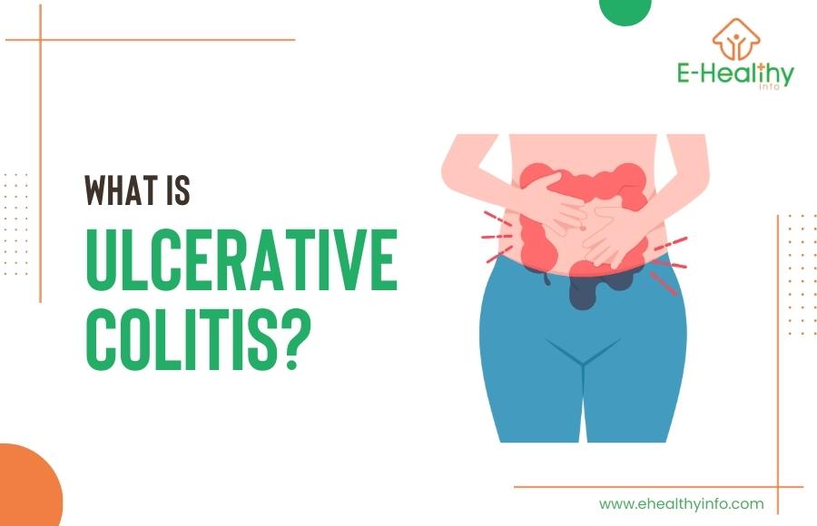 UC Uncovered: Symptoms, Causes, and Top Treatment Solutions for Ulcerative Colitis