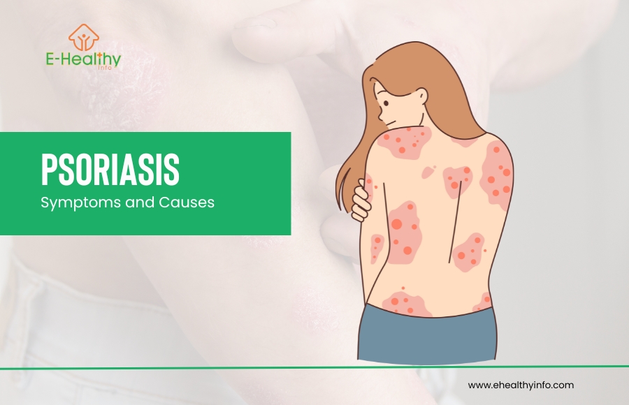 Understanding Psoriasis: Causes, Symptoms, and Effective Treatments