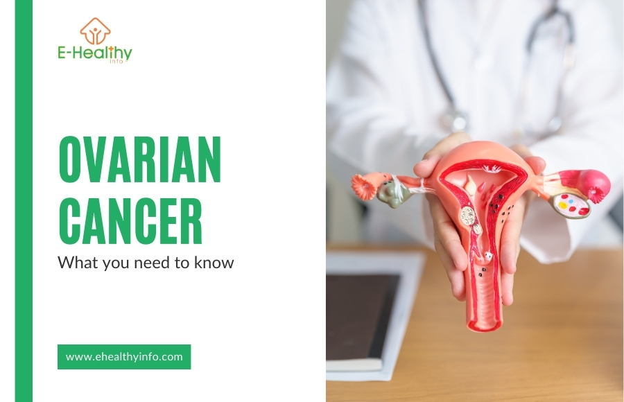 The Essential Guide to Ovarian Cancer – What You Need to Know for Empowered Health