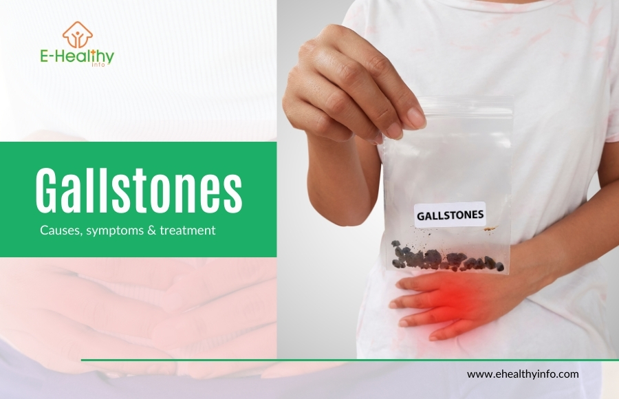 Gallstones(Cholelithiasis) – Causes, Symptoms & Treatment