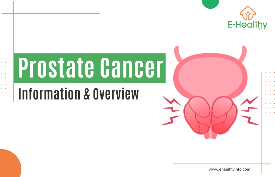 Understanding Prostate Cancer: Causes, Risks, Diagnosis, and Treatment