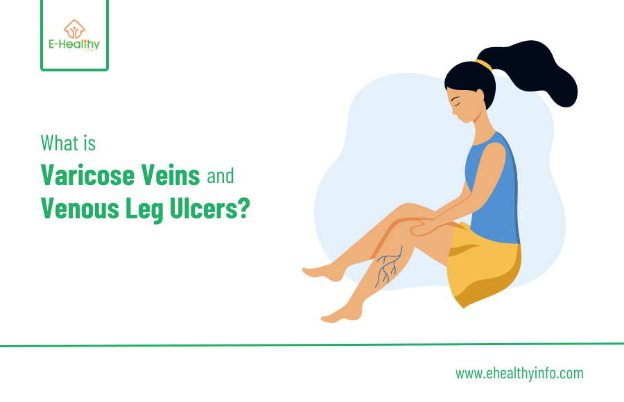 What are Varicose Vein and Venous Leg Ulcers?