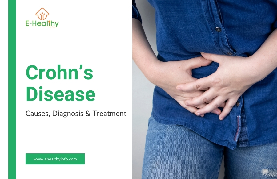 Crohn’s Disease – Symptoms, Causes, Diagnosis and Treatment