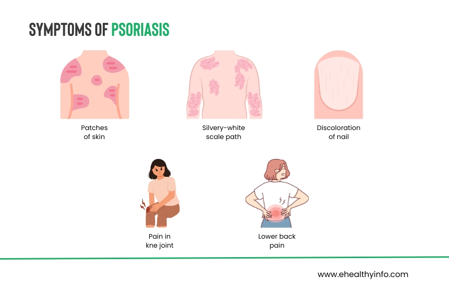 Psoriasis Symptoms