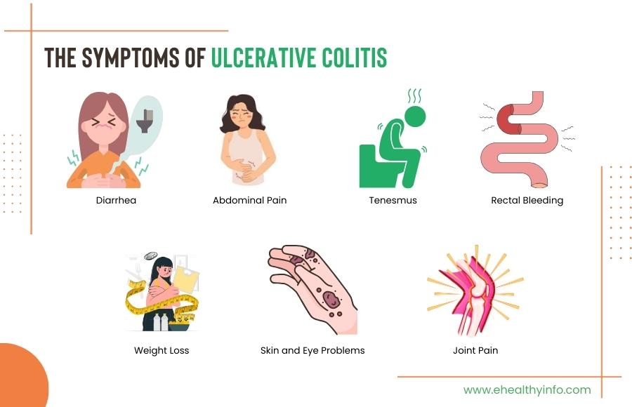 Ulcerative Colitis Symptoms