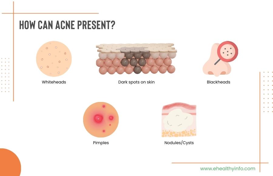 Symptoms of acne 
