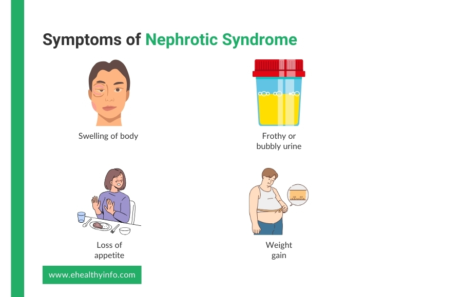 nephrotic syndrome symptoms