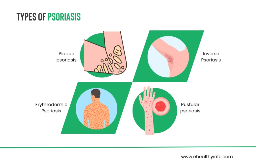 Types Of Psoriasis