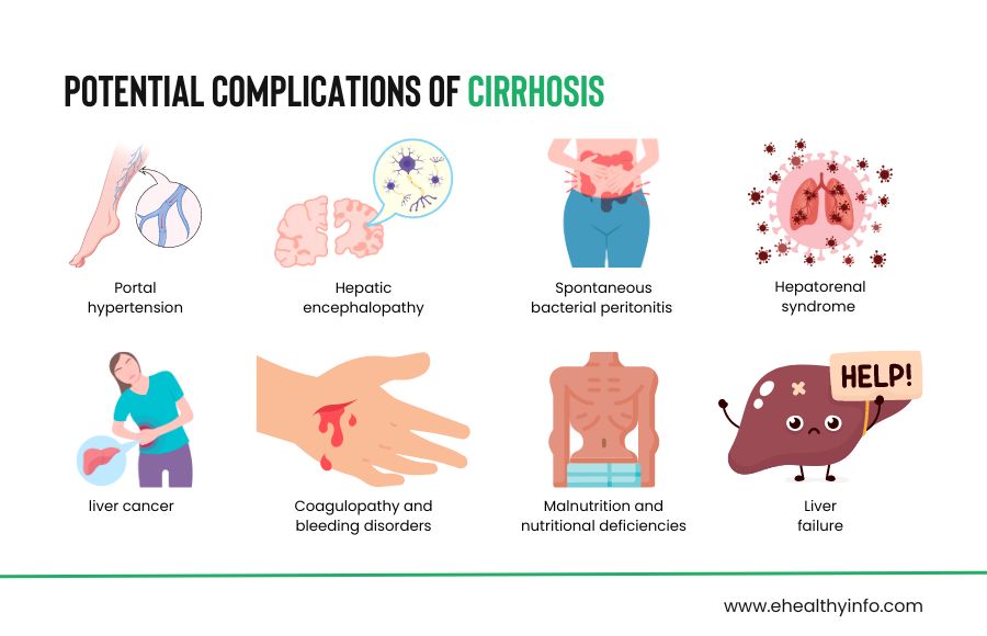 Complications of liver cirrhosis