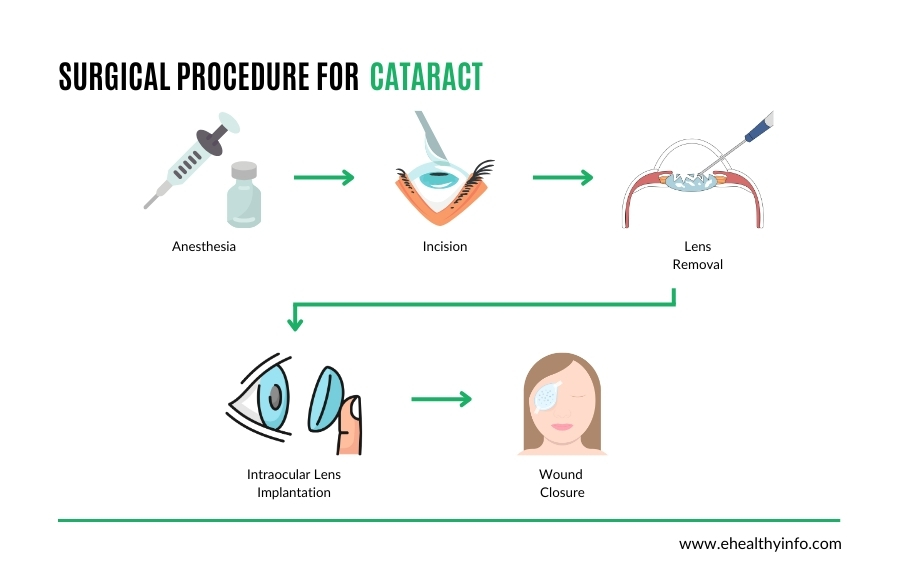 cataract removal surgery procedure