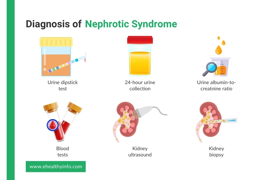 diagnose of nephrotic syndrome