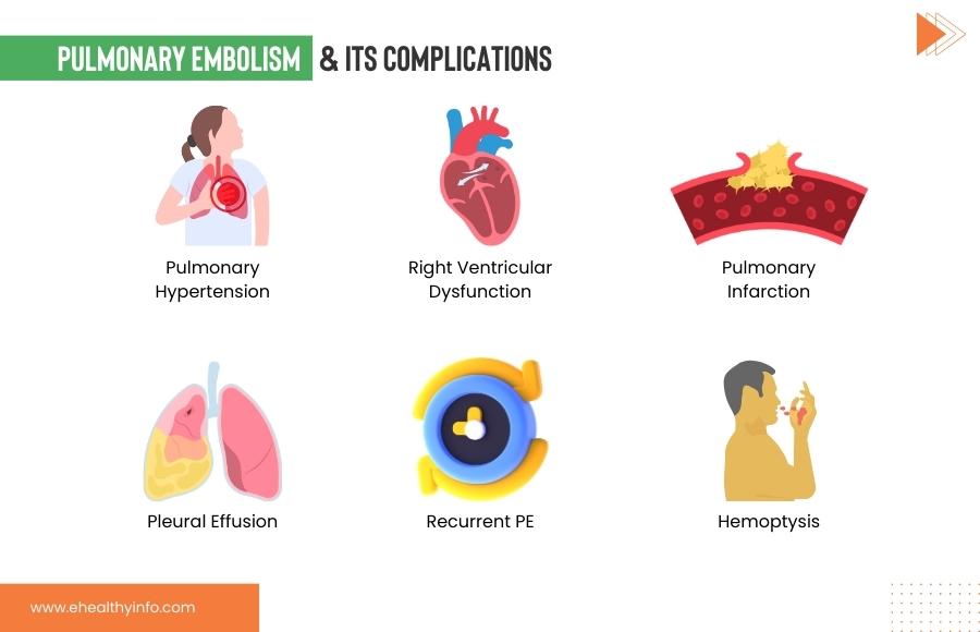 Pulmonary Embolism Complications