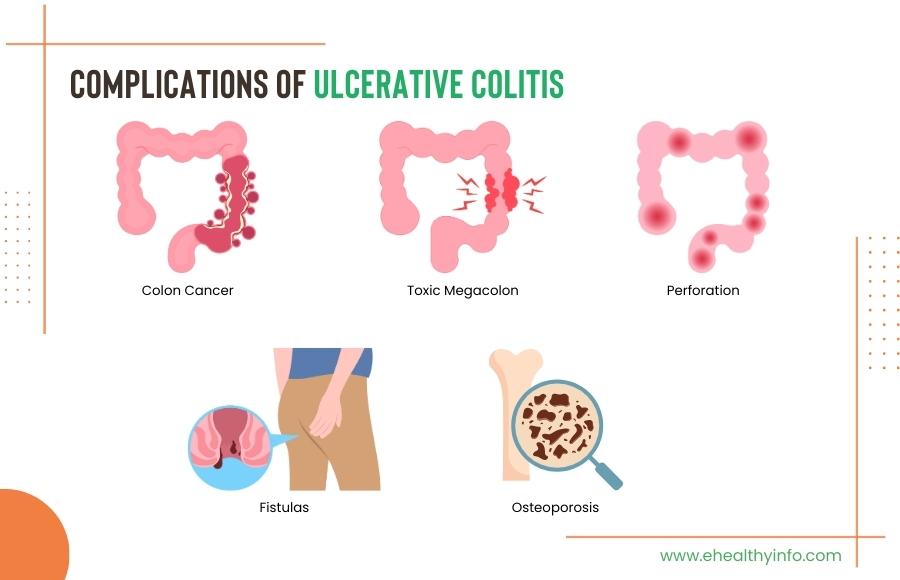 Ulcerative Colitis Complications