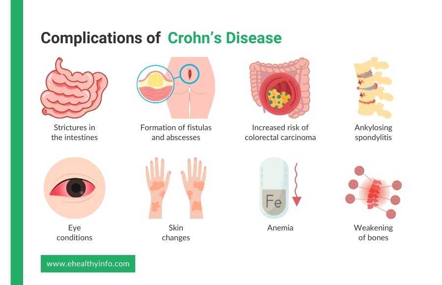 complications of crohn's disease