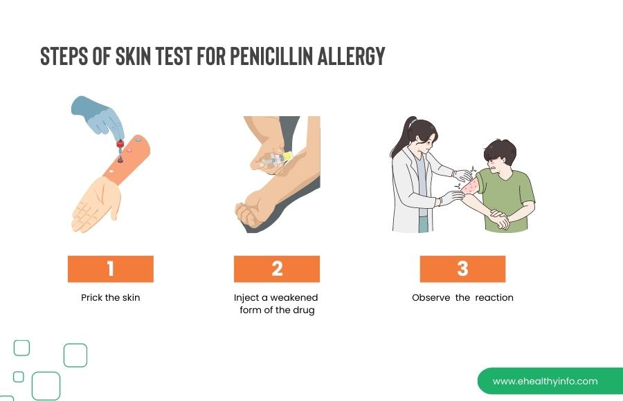 Steps of skin test for penicillin allergy