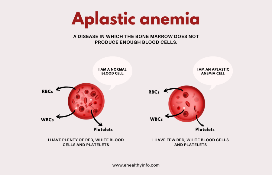 Aplastic Anemia – Symptoms, Causes, and Treatments