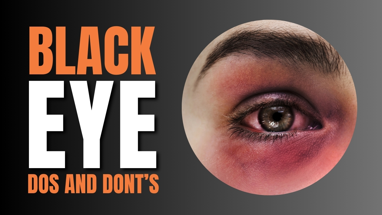 Discover Do’s and Don’t For A Black Eye Treatment