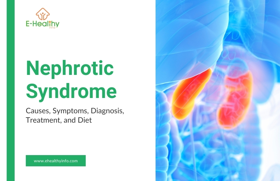 Understanding Nephrotic Syndrome: Causes, Symptoms, Diagnosis, Treatment, and Diet