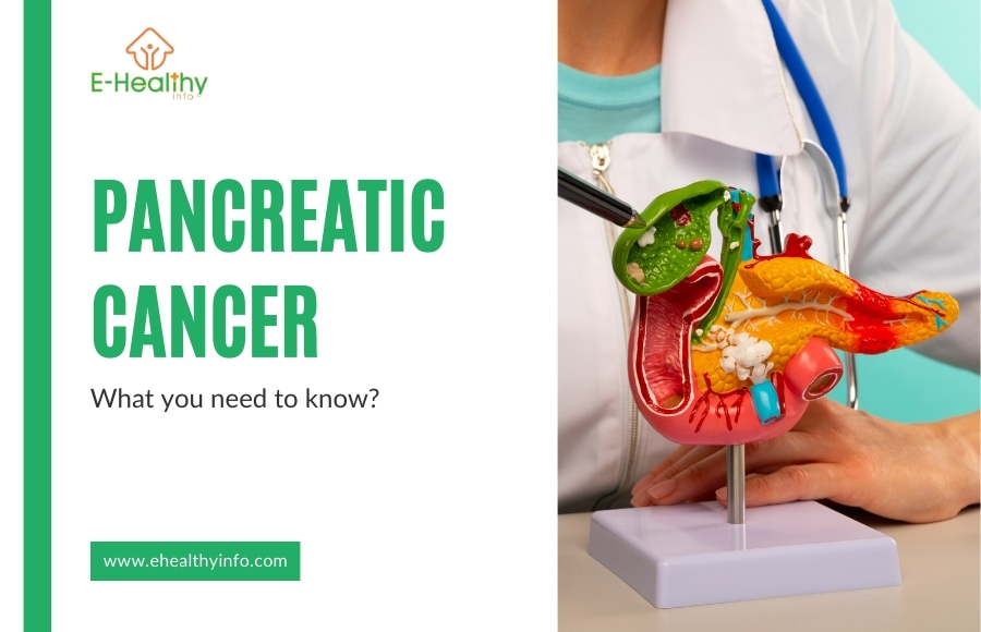 Pancreatic Cancer: Types, Risks, Symptoms, Diagnosis, Treatment & Complications