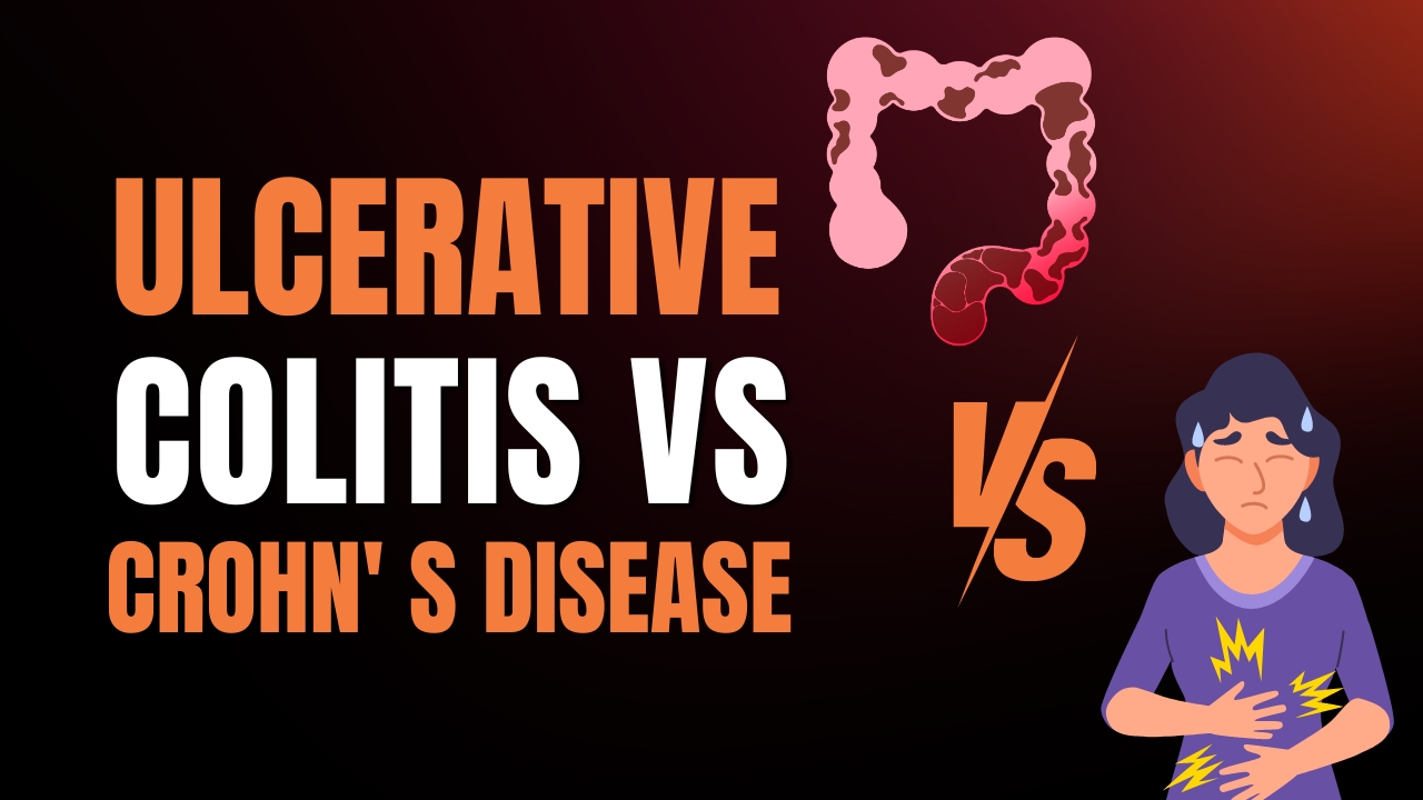 Ulcerative Colitis vs. Crohn’s Disease: What You Need to Know?