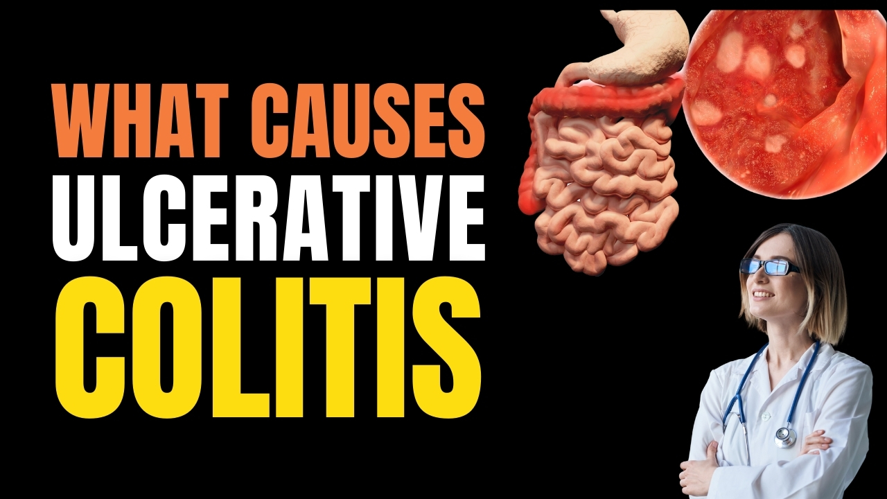 What Causes Ulcerative Colitis?