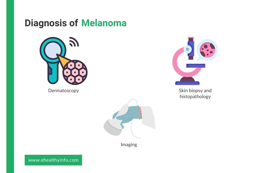 melanoma diagnosis