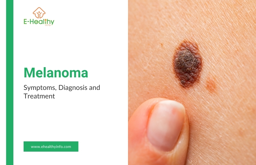 Melanoma Explained: Symptoms, Stages, and How to Spot Skin Cancer