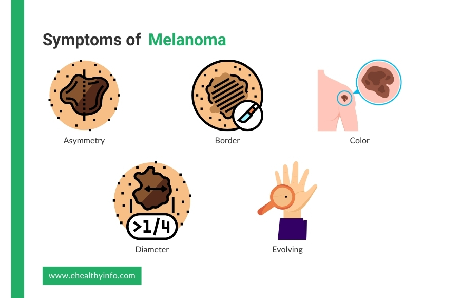 melanoma symptoms