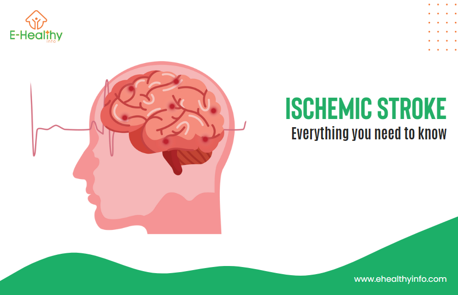 Ischemic Stroke