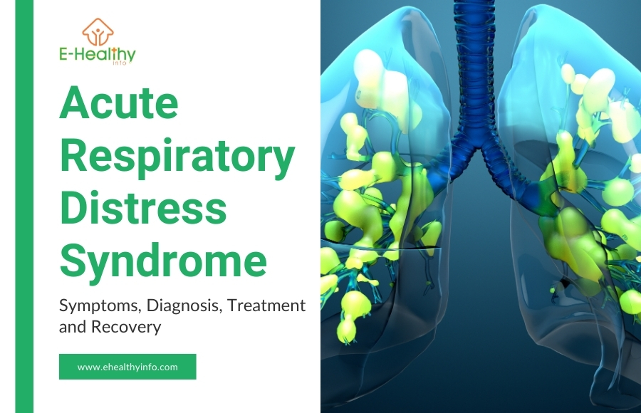 Acute Respiratory Distress Syndrome (ARDS) - Symptoms And Treatment