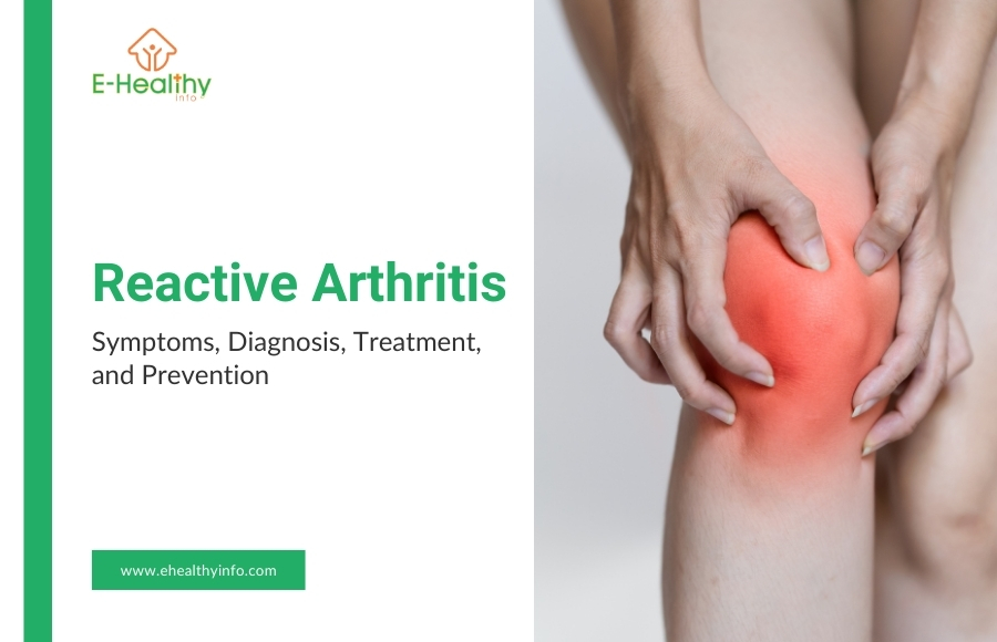 Reactive Arthritis – Symptoms, Diagnosis, Treatment, and Prevention