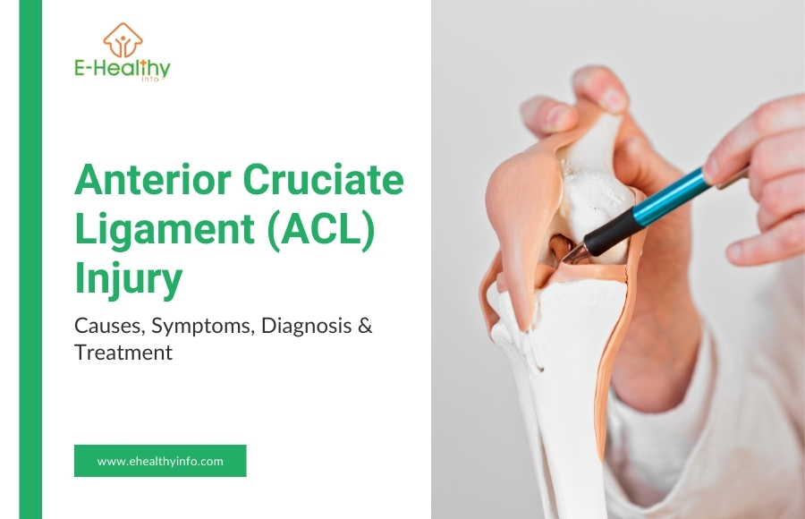 ACL Injury: Discover the Causes, Symptoms, and Effective Treatments