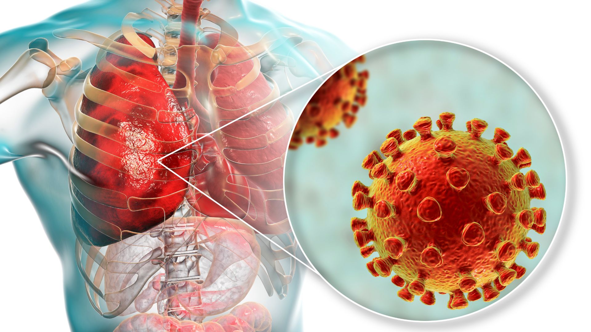 5 facts about pneumonia