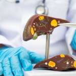 Hepatocellular Carcinoma – Warning Signs, Risks & Life-Saving Treatments