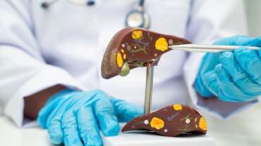 Hepatocellular Carcinoma – Warning Signs, Risks & Life-Saving Treatments