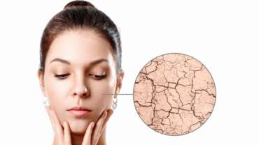 The zoom circle shows dry facial skin before moistening