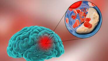 Ischemic Stroke – Symptoms, Causes and Treatment