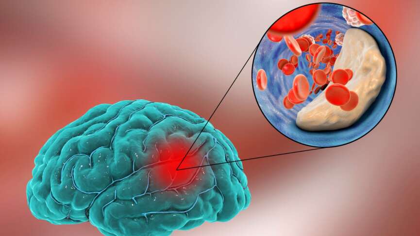 A ministroke, or transient ischemic attack or stroke in which blood flow in the brain blocked in an artery