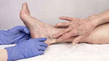 What are Varicose Vein and Venous Leg Ulcers?