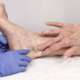 doctor examining painful varicose and spider veins on female legs