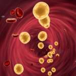 High Cholesterol – Risk Factors, Symptoms and Treatment
