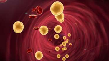 High Cholesterol – Risk Factors, Symptoms and Treatment