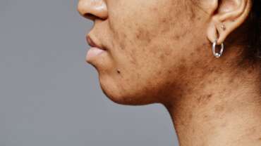 Acne – Causes, Symptoms and Prevention