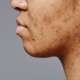 Close-up acne pimple treatment for skin problem skincare pimples acne, pores, scars, natural skin