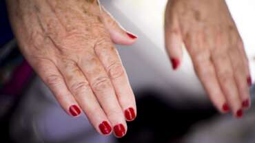 Understanding Lupus – Causes, Symptoms, and Treatment Options