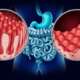 3d illustration of celiac disease, a serious autoimmune disorder where ingestion of gluten damages the small intestine