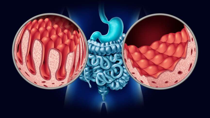 3d illustration of celiac disease, a serious autoimmune disorder where ingestion of gluten damages the small intestine